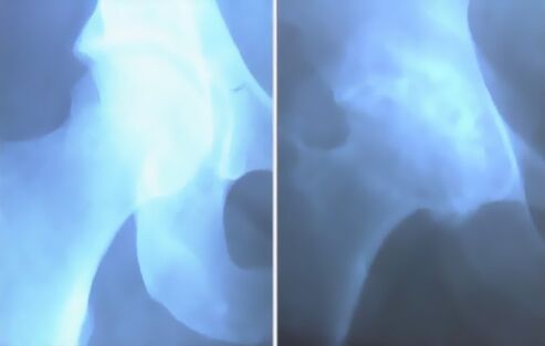 Écume ostéoarthritique de l'articulation du genou