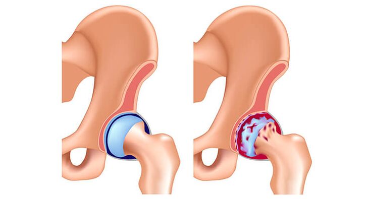 articulation de la hanche saine affectée par l'arthrose